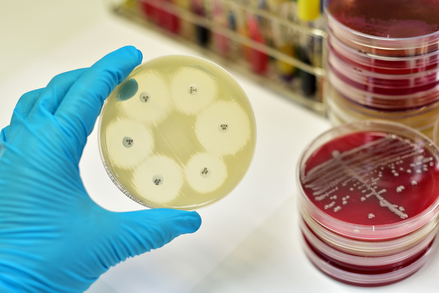 ‘Catastrophic’ superbug could flood hospitals